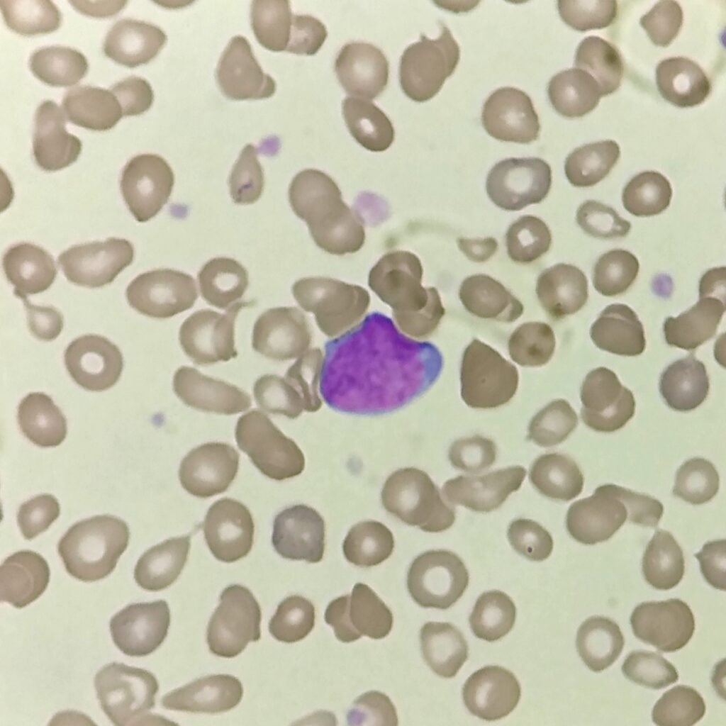 white blood cells: blast cell