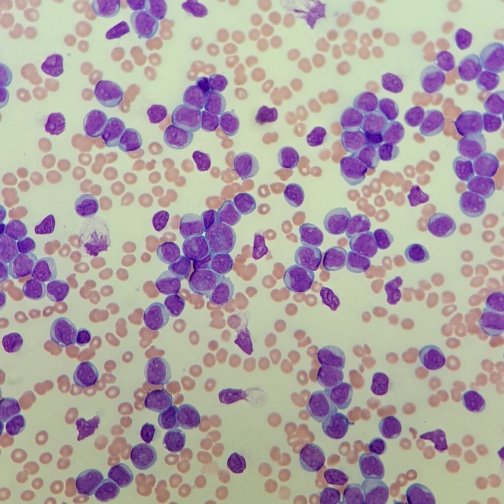 white blood cells: blast cells