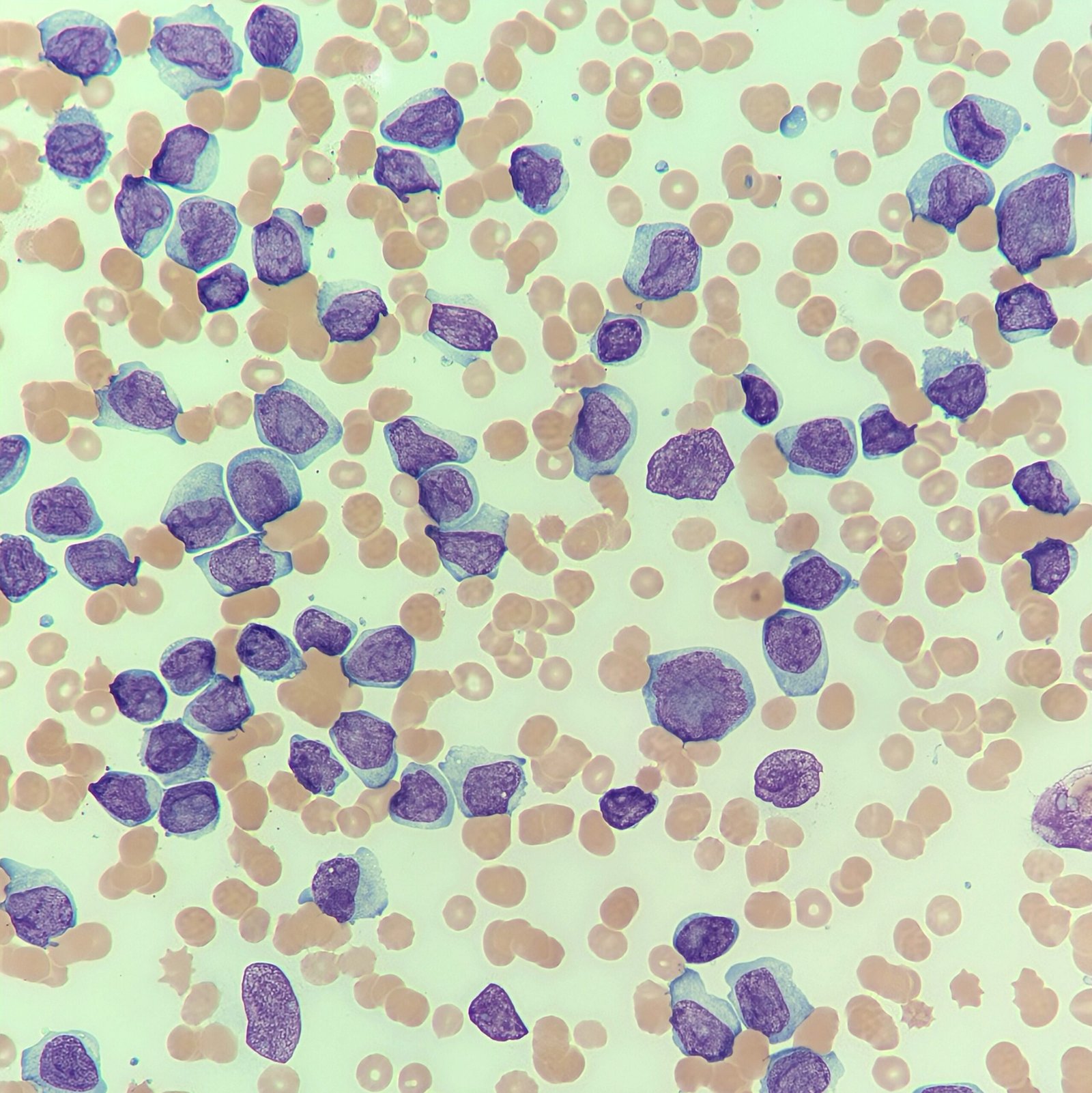 Diff Blasts Blast Peripheral Blood Smear
