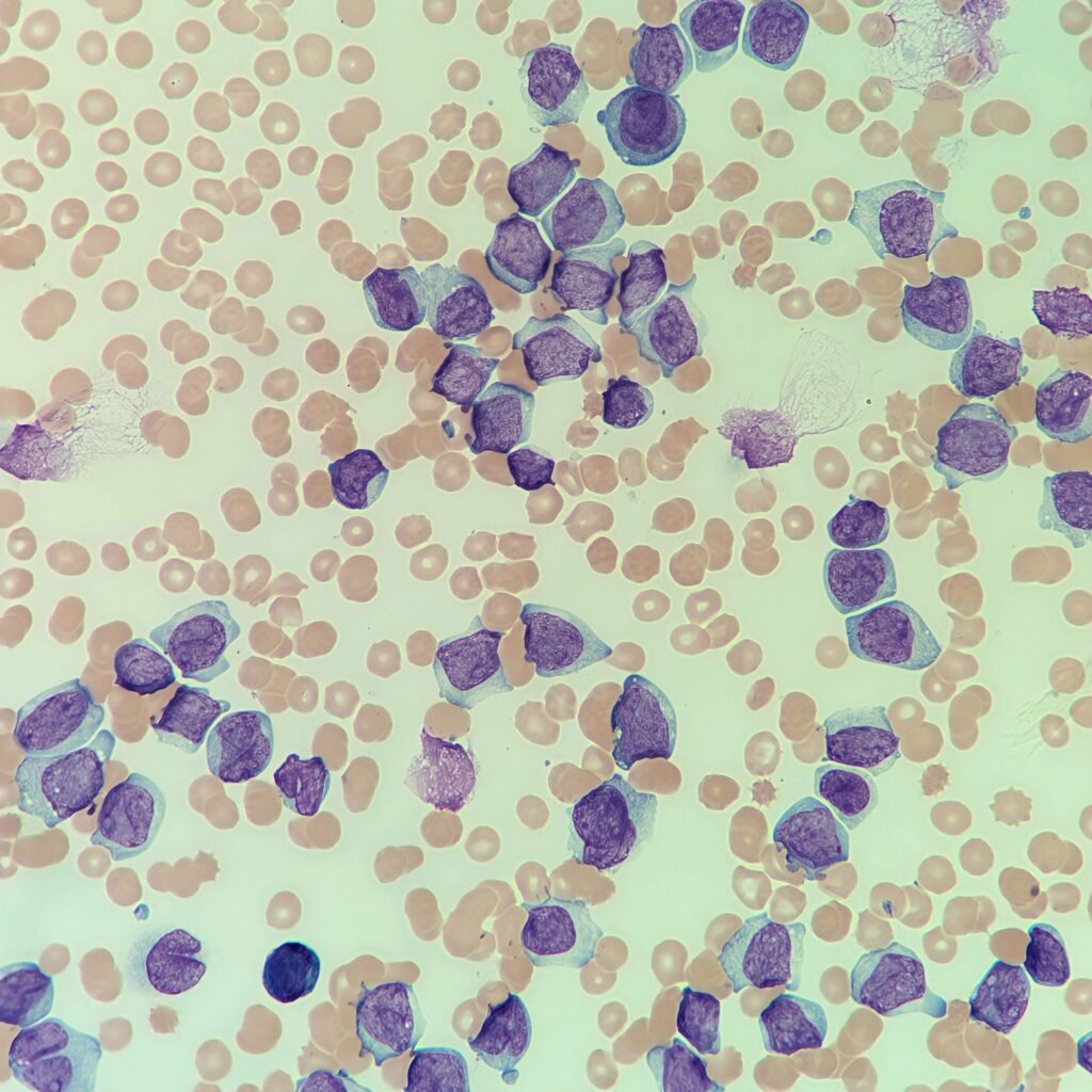 white blood cells: blast cells
