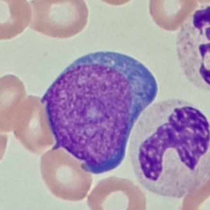 white blood cell: blast cell
