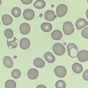 RBC Morphology Based on Shape