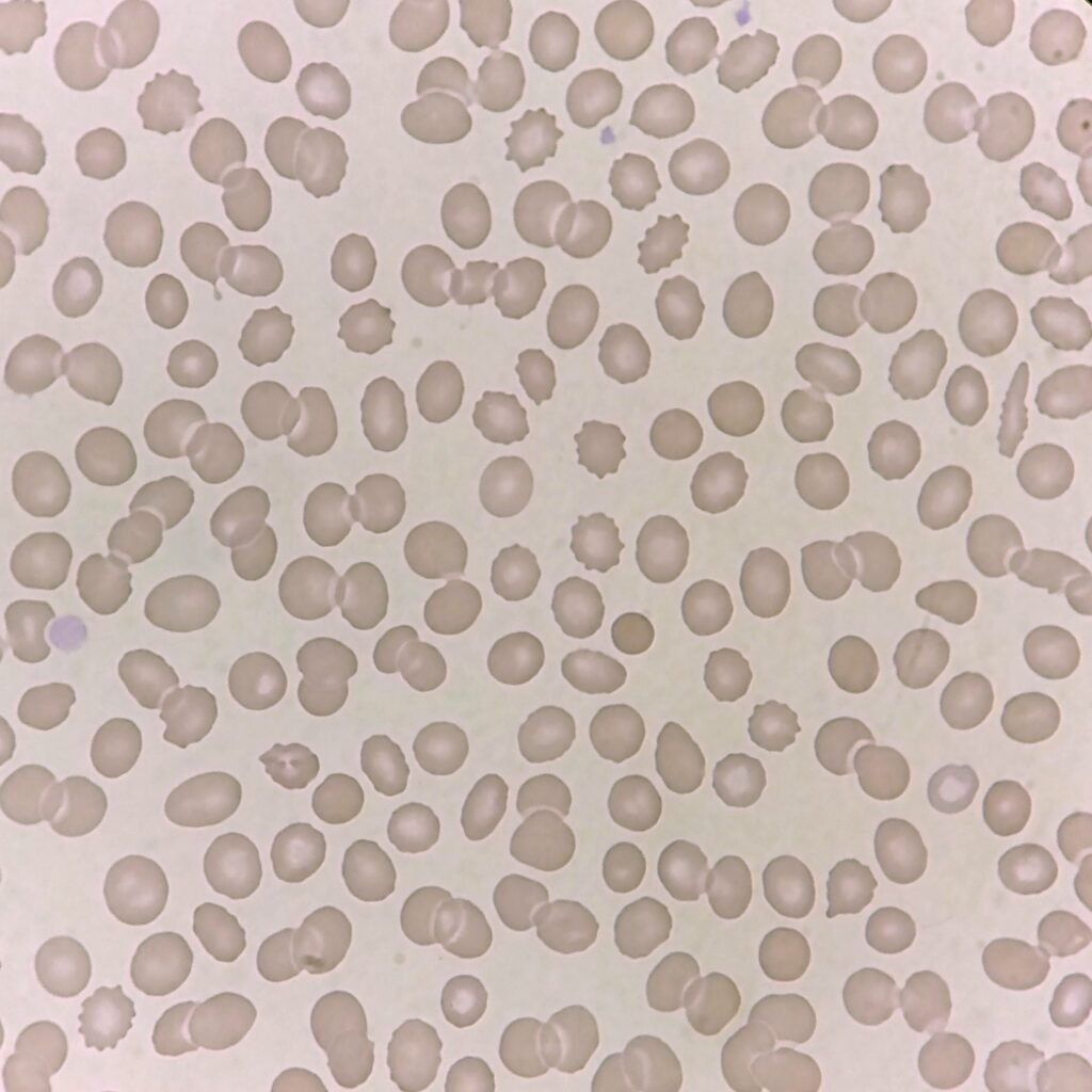 Burr Cells (Echinocytes)