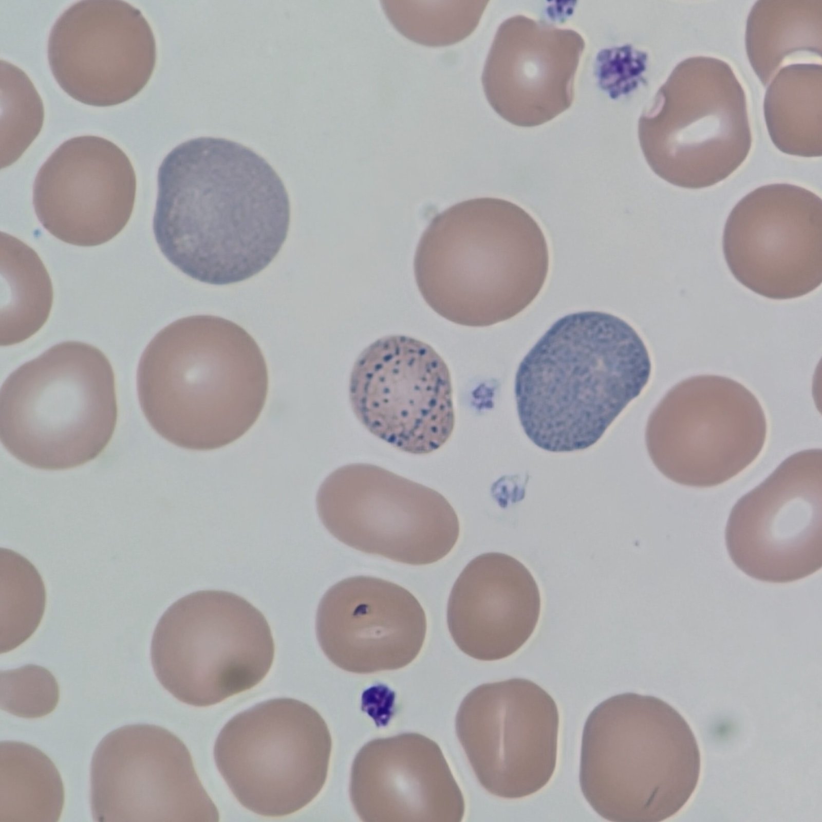 Cabot Ring, red blood cell inclusion