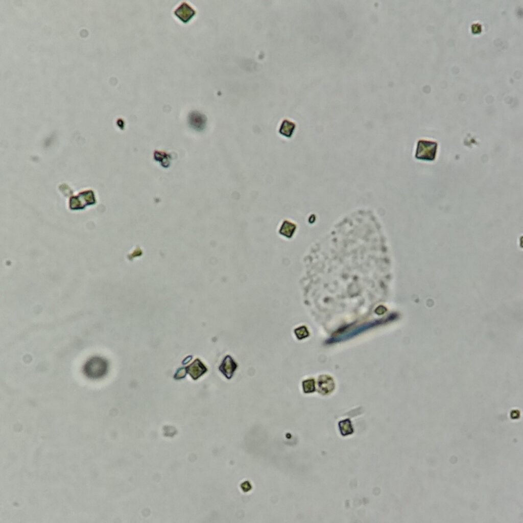 Calcium Oxalate Crystals (Dihydrate)