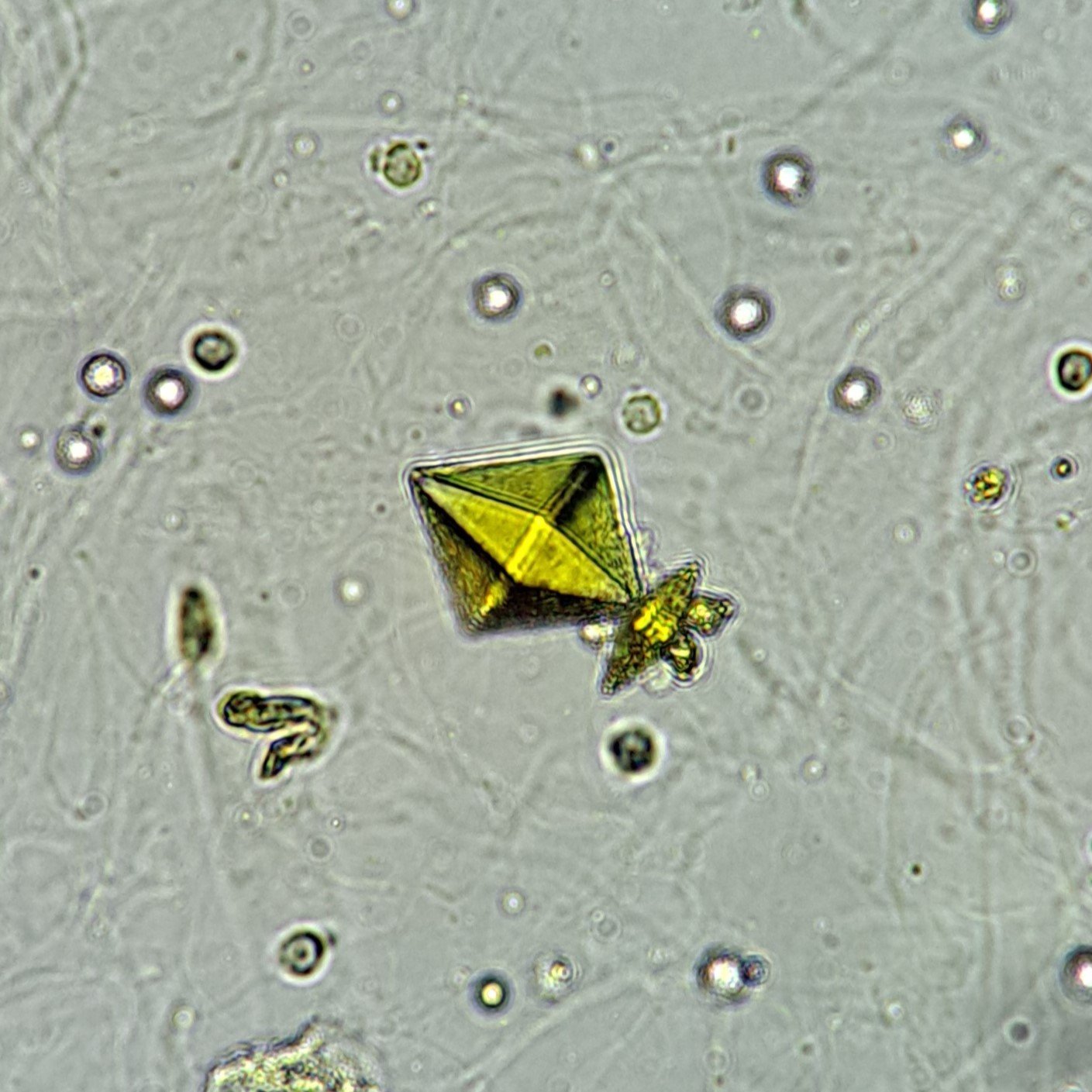 Calcium Oxalate Crystals in urine sediment, Dihydrate