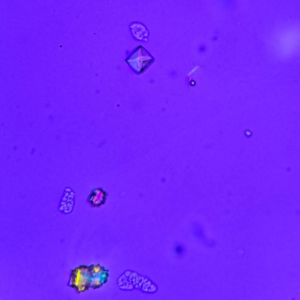 Calcium Oxalate Crystals (Dihydrate), Polarized)