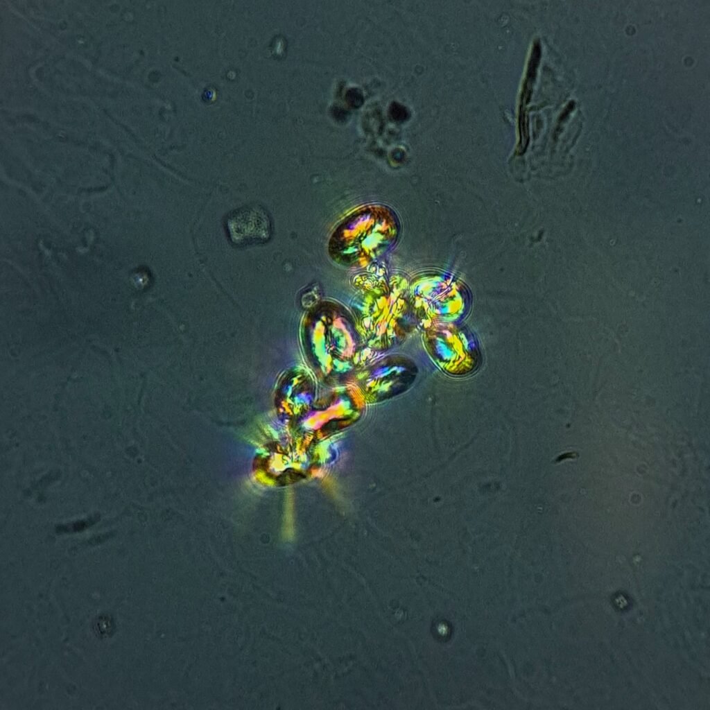 Calcium Oxalate Crystals (Monohydrate), Polarized