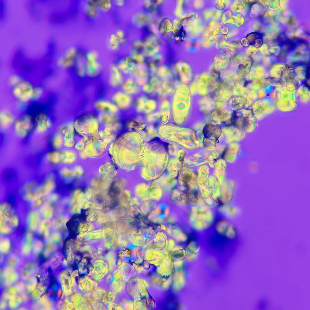 Calcium Oxalate Crystals in urine sediment, Monohydrate, Polarized