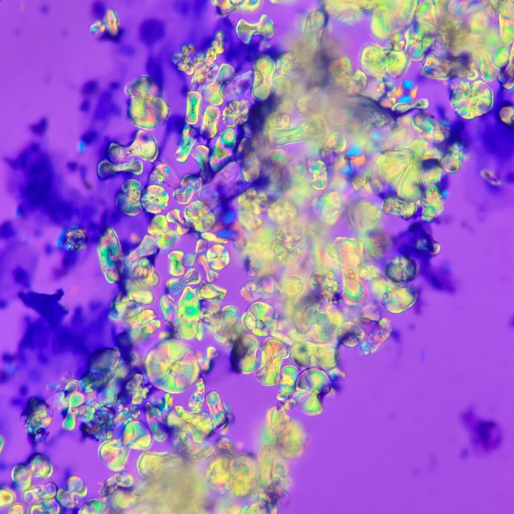 Calcium Oxalate Crystals in urine sediment, Monohydrate, Polarized