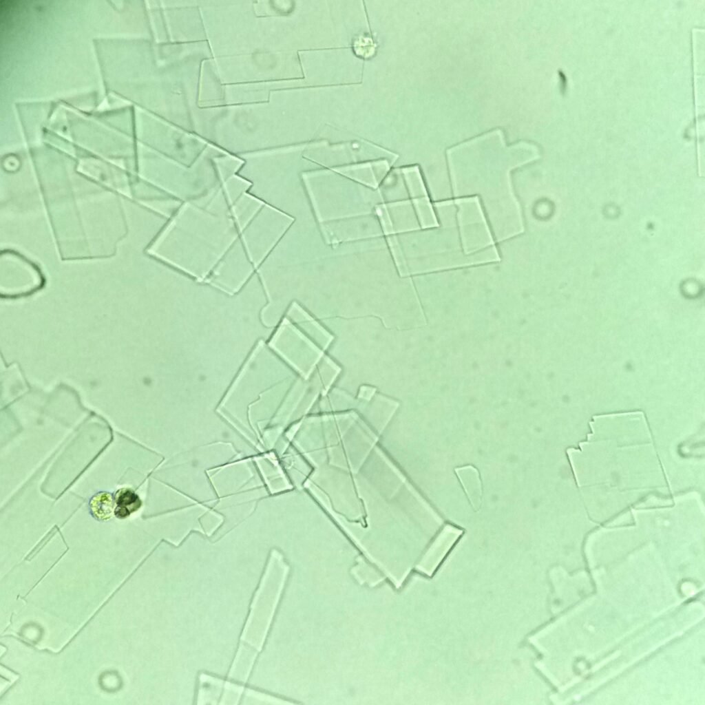 Cholesterol crystals in body fluid