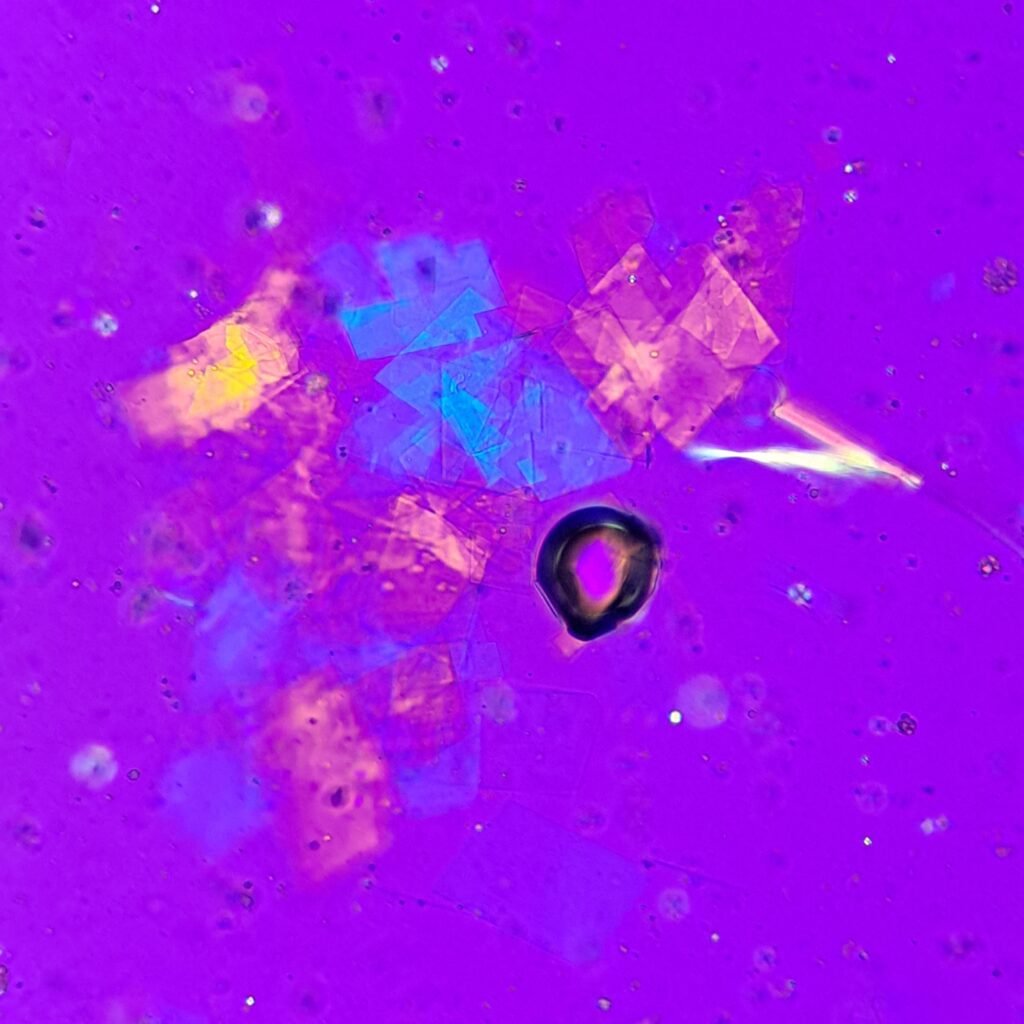 Cholesterol crystals in body fluid (polarized) with lipid/fat droplets showing maltese crosses