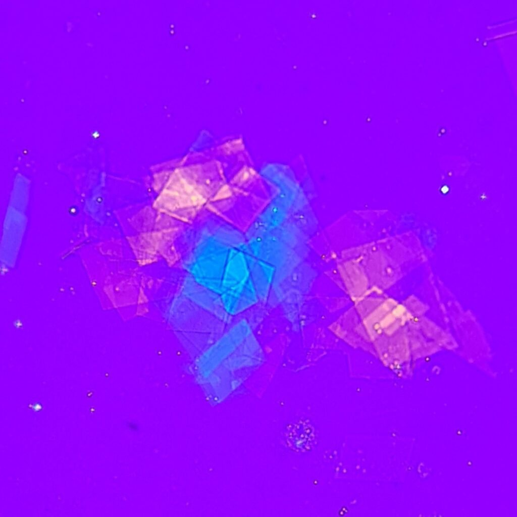 Cholesterol crystals in body fluid (polarized) with lipid/fat droplets showing maltese crosses