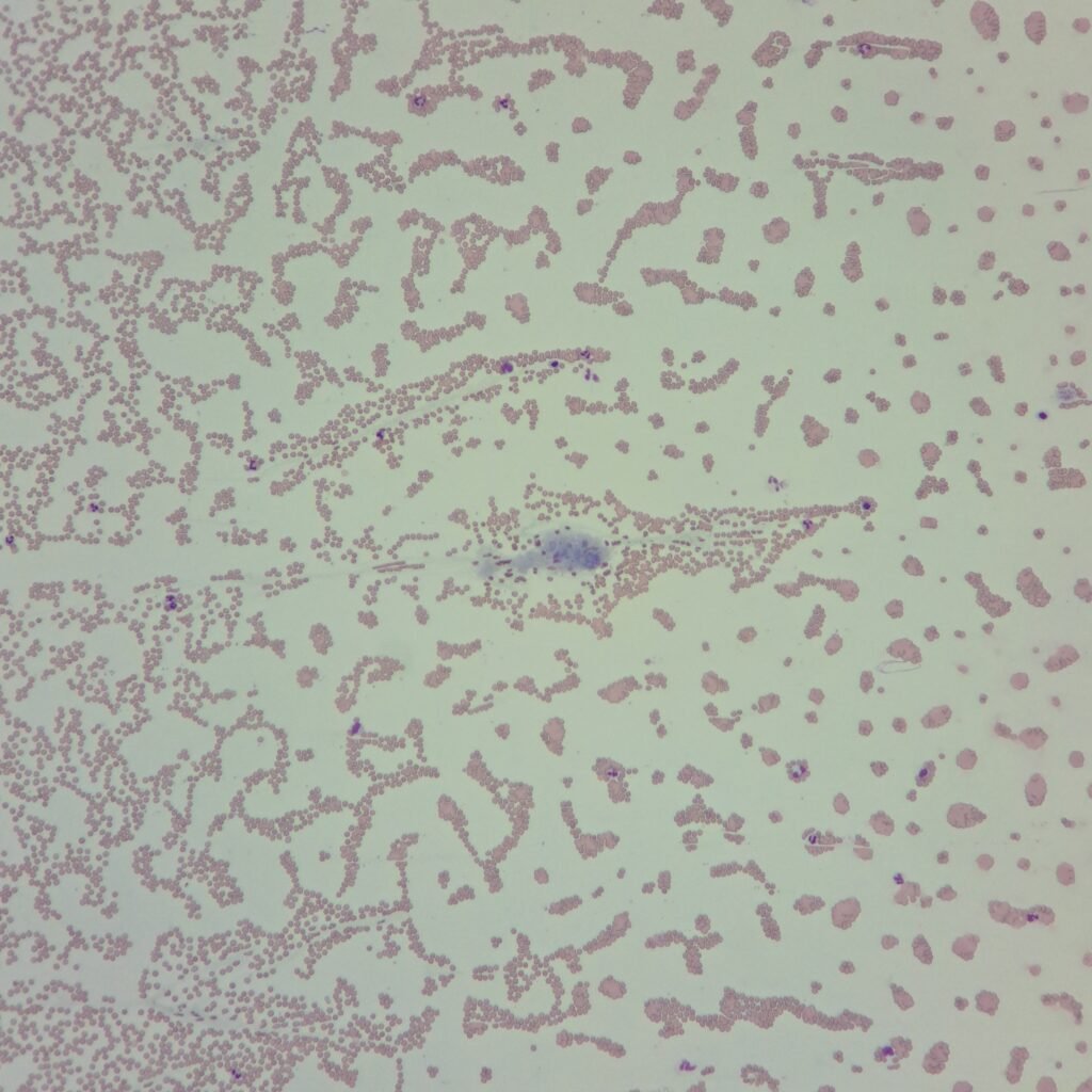 Clot in feathered edge of smear with fibrin strands
