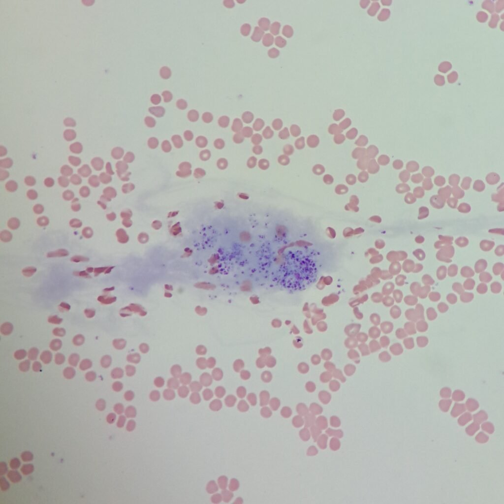 Clot in feathered edge of smear with fibrin strands