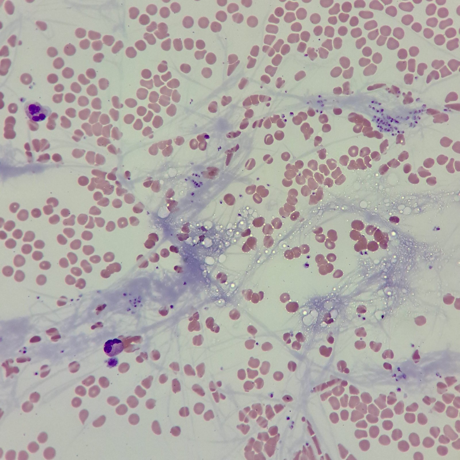 Clot in feathered edge of smear with fibrin strands
