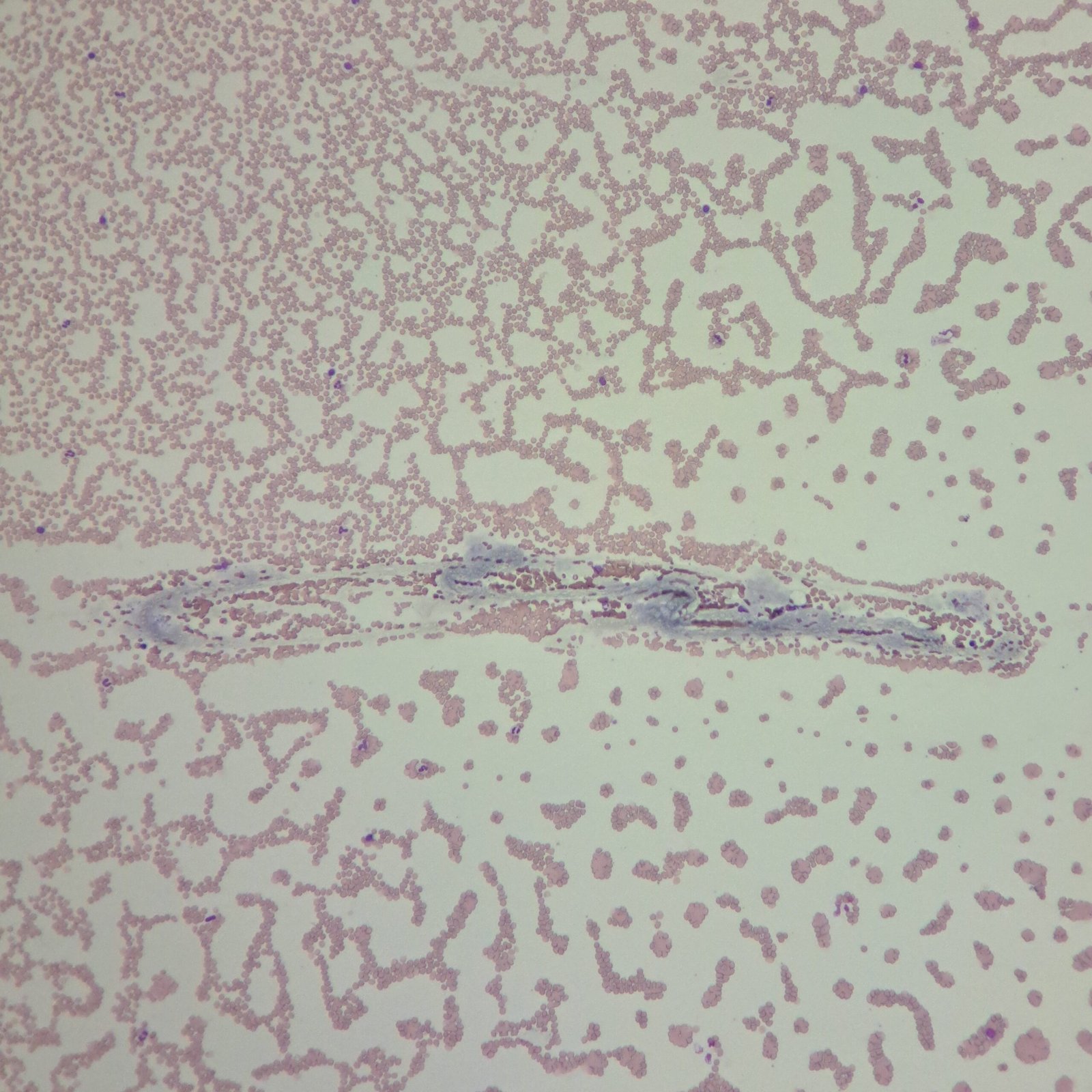 Clot in feathered edge of smear with fibrin strands