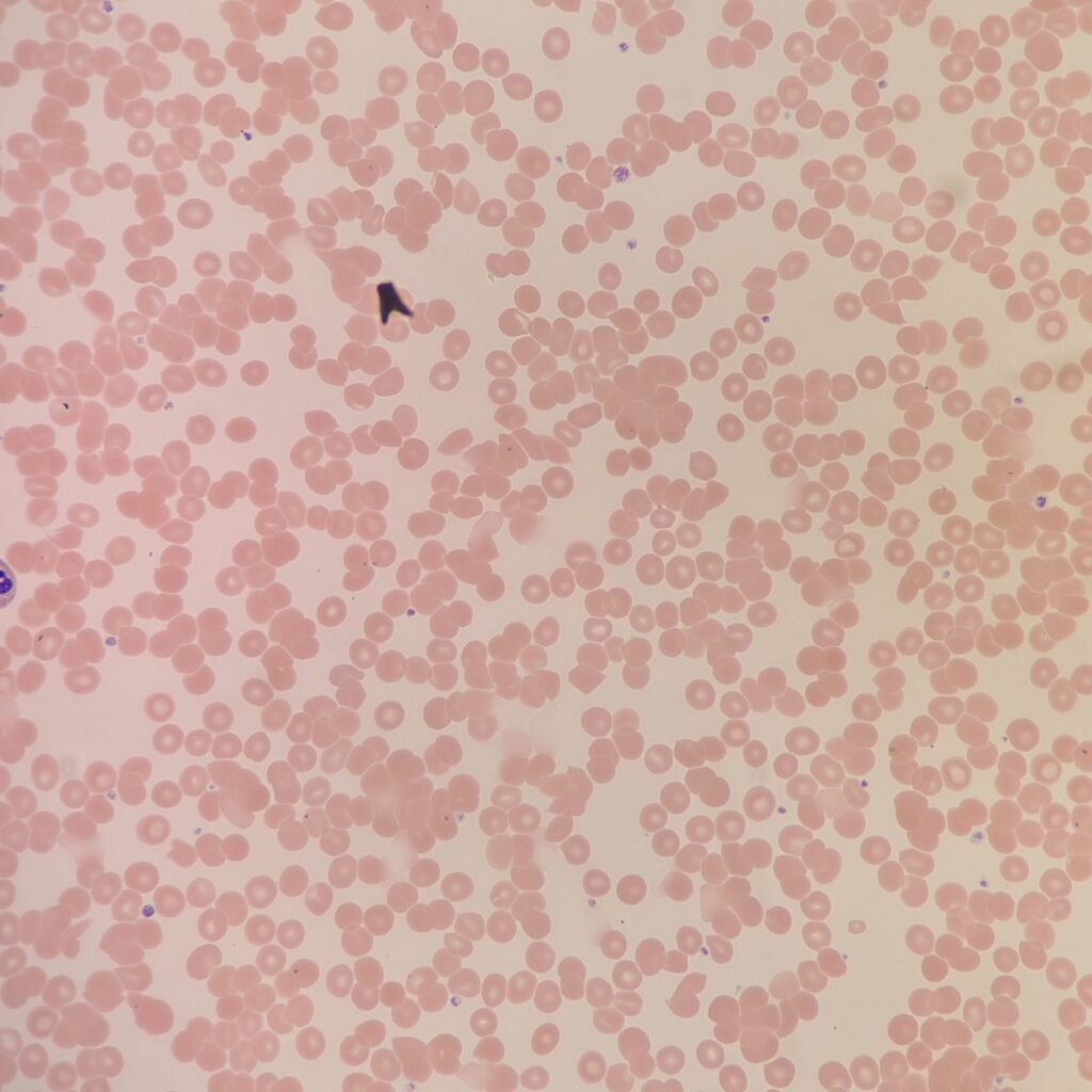 Red blood cells on a slide agglutinating/clumping together from a cold agglutinin.