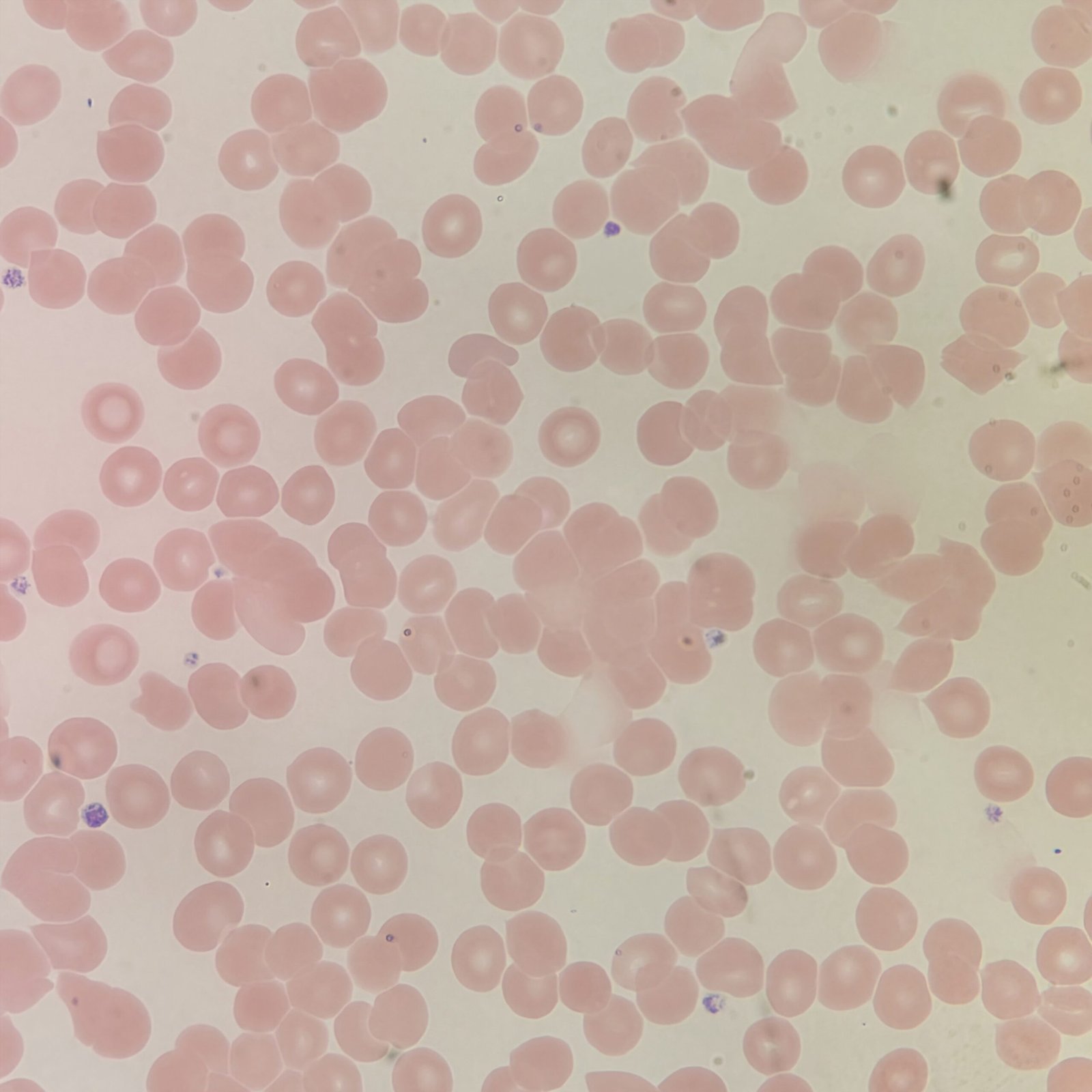 Red blood cells on a slide agglutinating/clumping together from a cold agglutinin.
