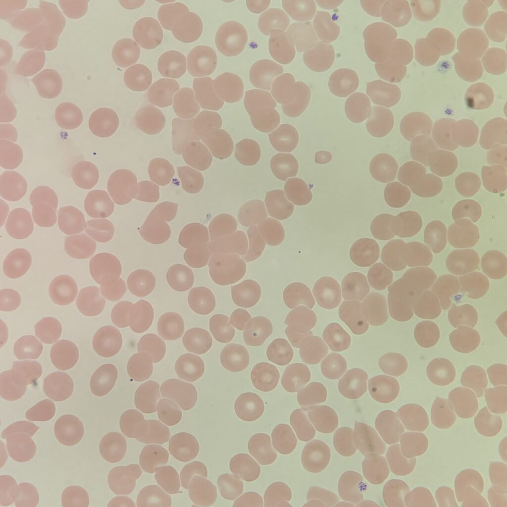 Red blood cells on a slide agglutinating/clumping together from a cold agglutinin.