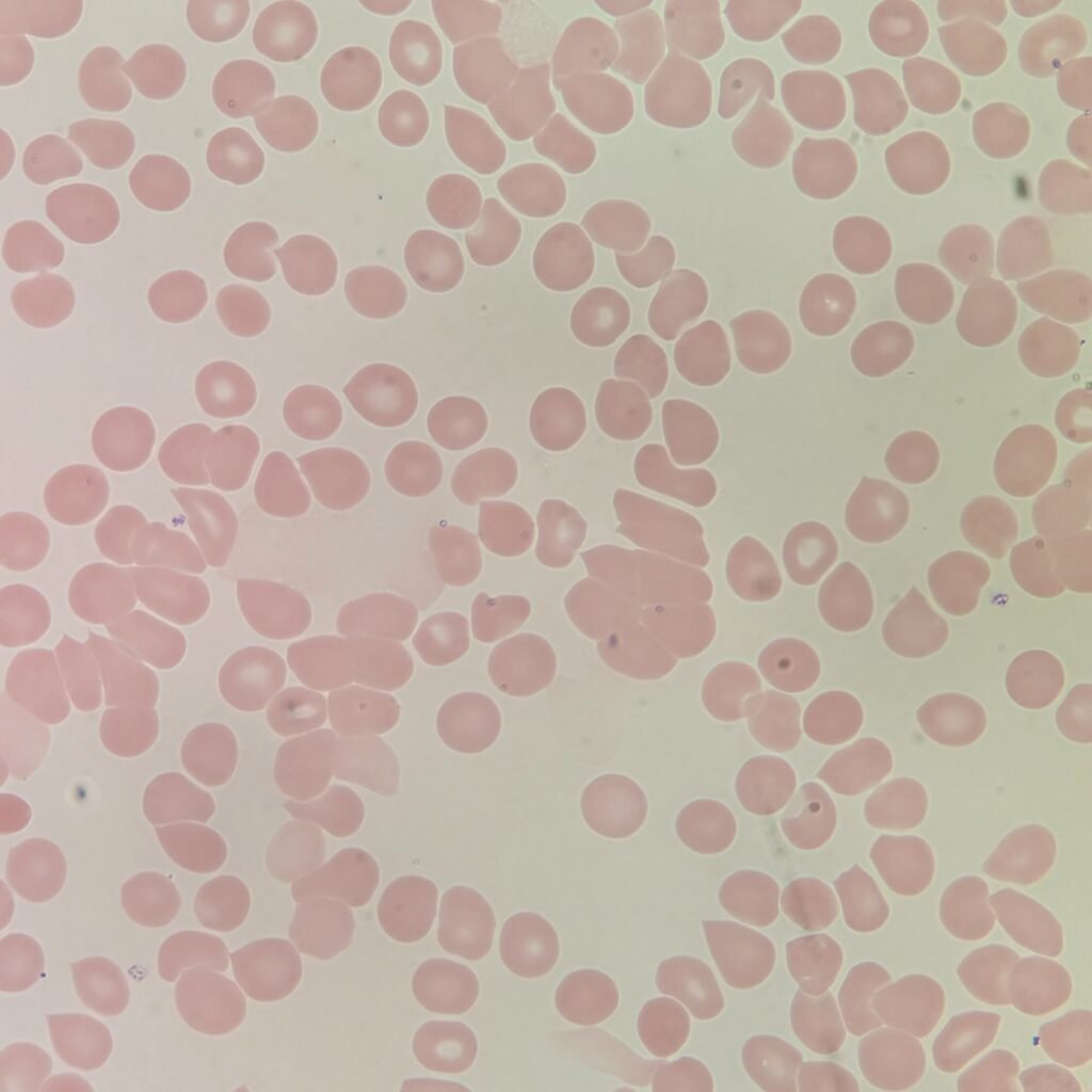 Red blood cells on a slide agglutinating/clumping together from a cold agglutinin.