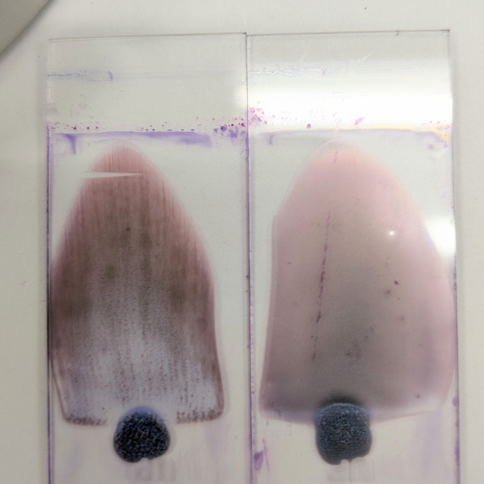 A comparison of a blood smear before and after warming the specimen of a patient with a cold agglutinin.