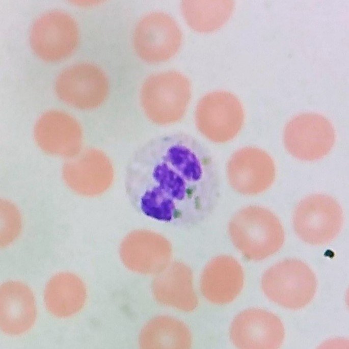 Critical Green Inclusion in Neutrophil. AKA "Green Crystals of Death"