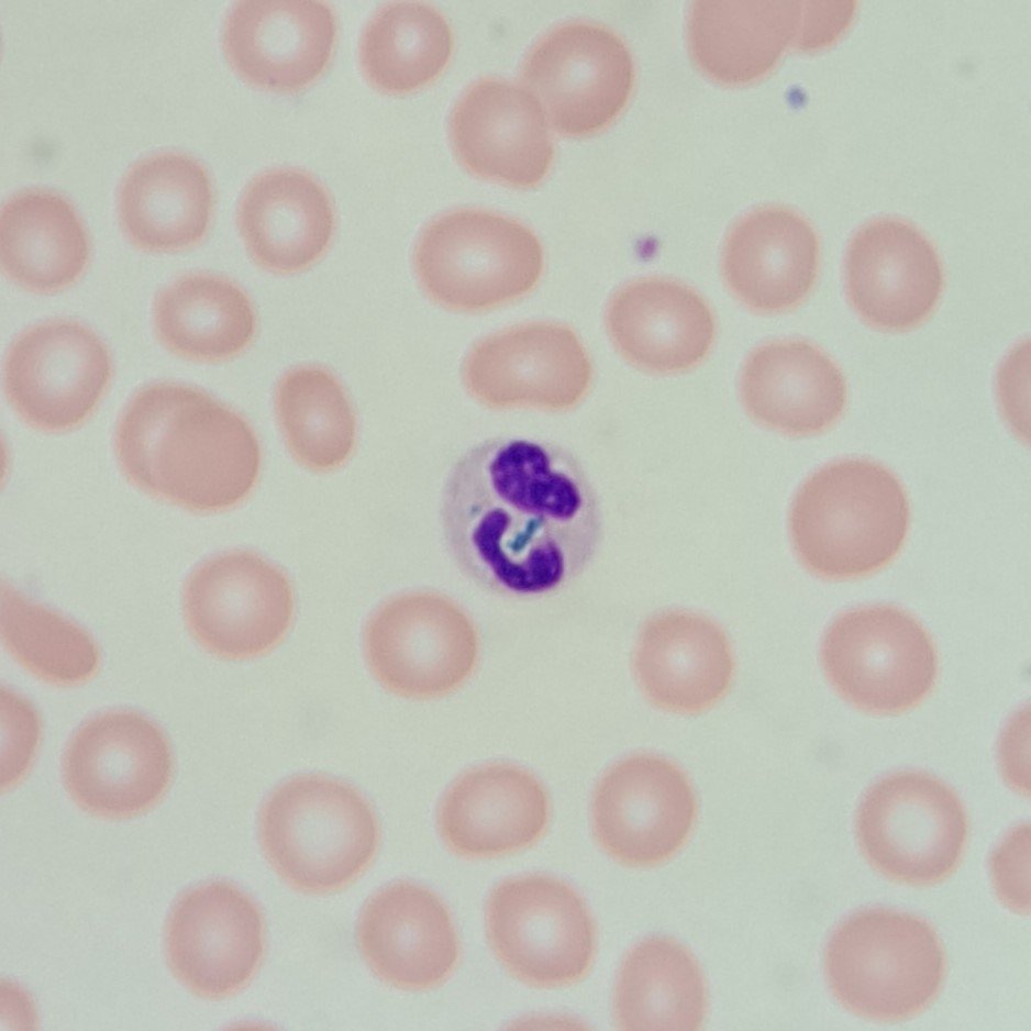 Critical Green Inclusion in Neutrophil. AKA "Green Crystals of Death"