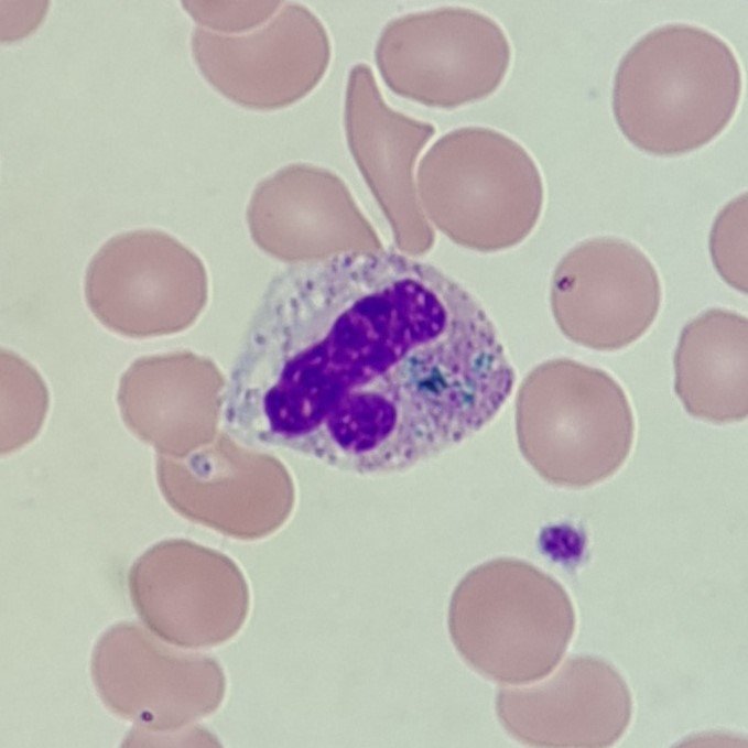 Critical Green Inclusion in Neutrophil. AKA "Green Crystals of Death"