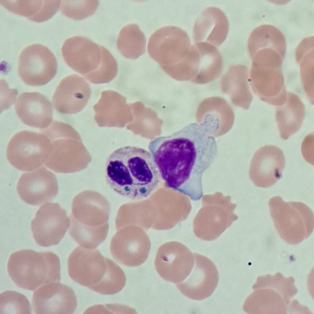 Critical Green Inclusion in Neutrophil. AKA "Green Crystals of Death"