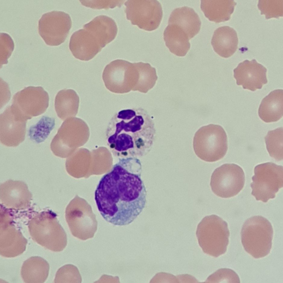 Critical Green Inclusion in Neutrophil. AKA "Green Crystals of Death"