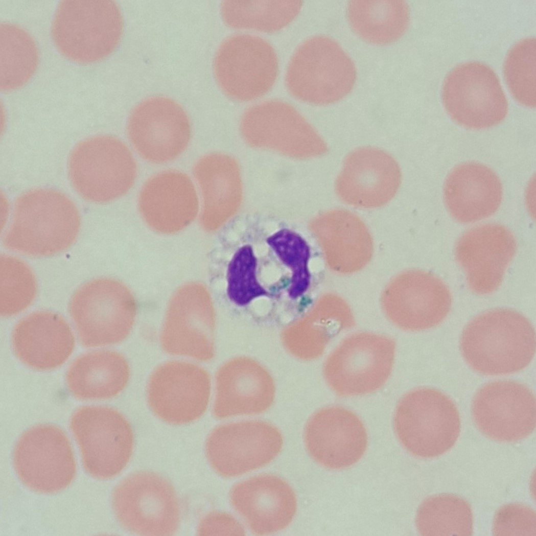 Critical Green Inclusion in Neutrophil. AKA "Green Crystals of Death"