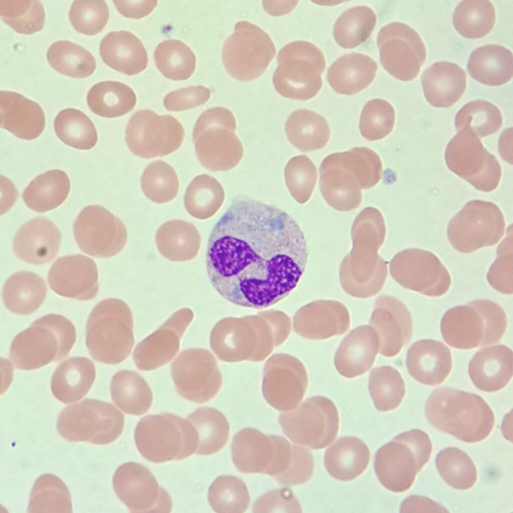 Dohle Bodies in Neutrophil