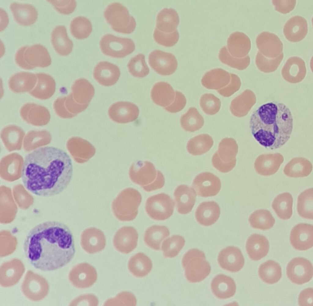 Dohle Bodies in Neutrophil