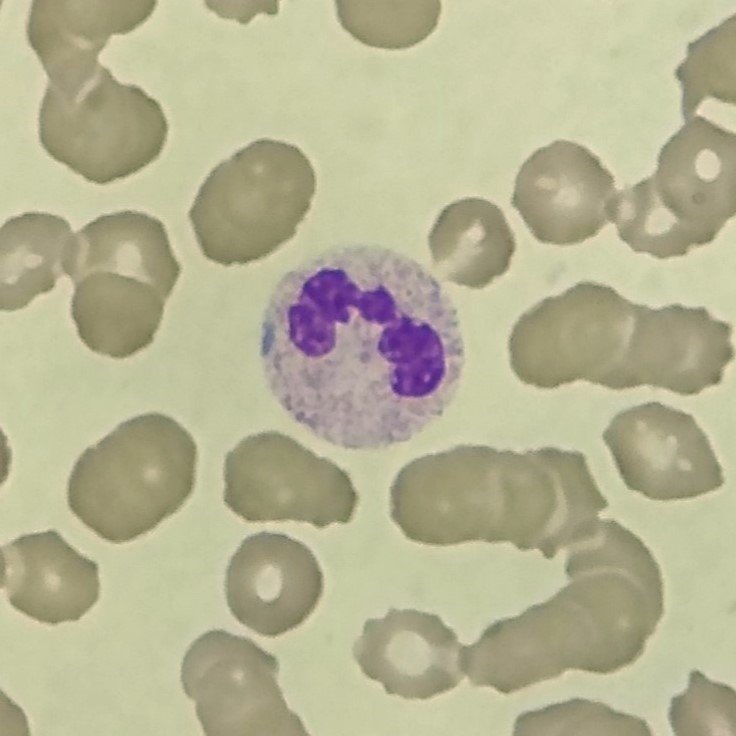 Dohle Bodies in Neutrophil
