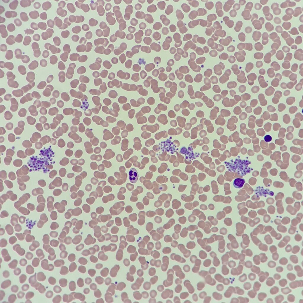 Platelet clumps caused by EDTA-dependent clumping
