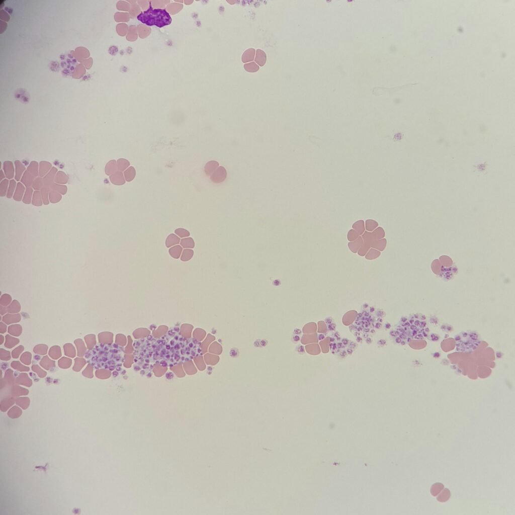Platelet clumps caused by EDTA-dependent clumping