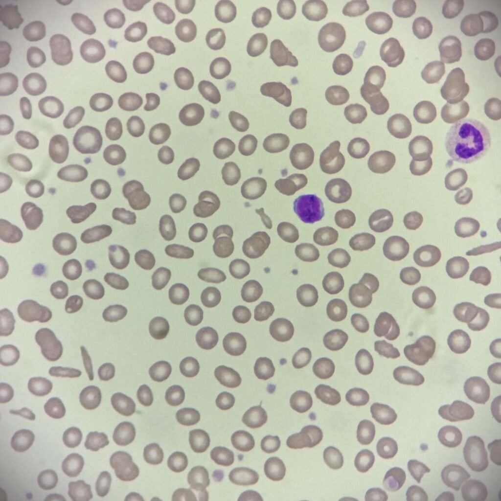 Elliptocytes / Ovalocytes