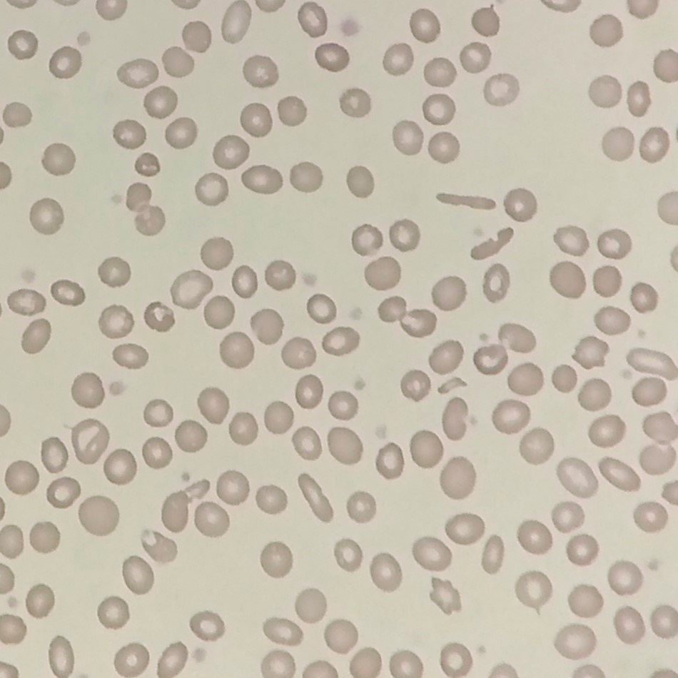Elliptocytes / Ovalocytes
