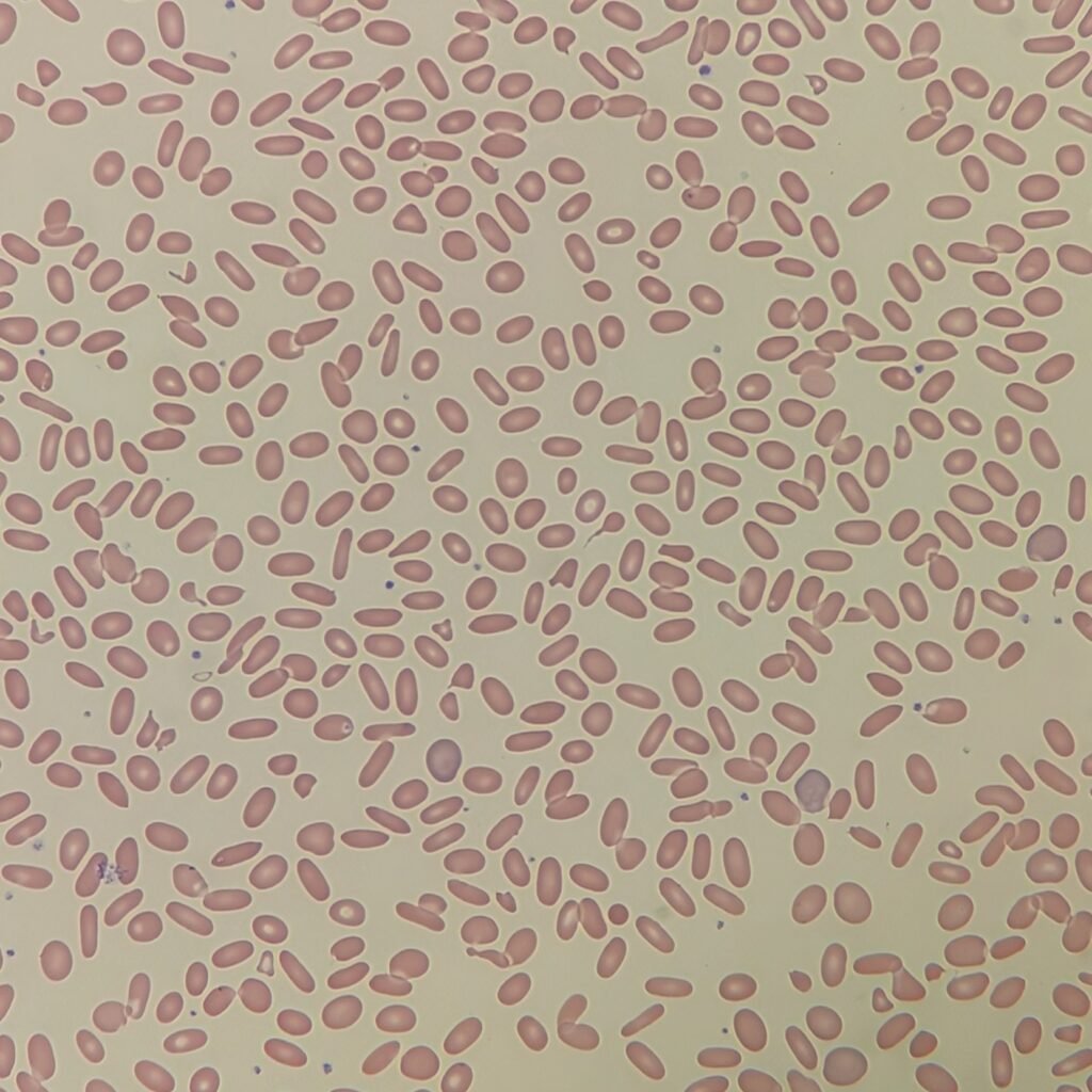 Elliptocytes/Ovalocytes, red blood cell morphology