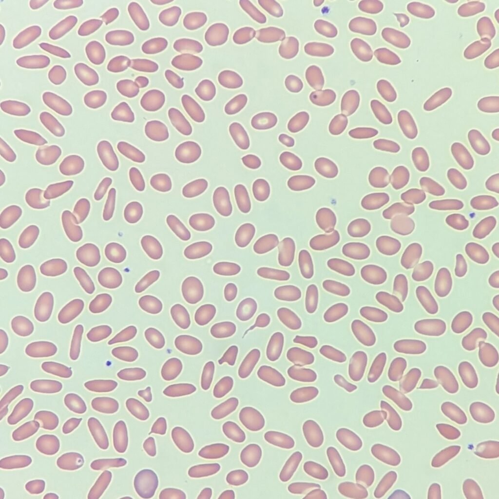 Elliptocytes/Ovalocytes, red blood cell morphology