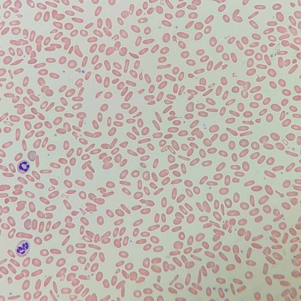 Elliptocytes/Ovalocytes, red blood cell morphology