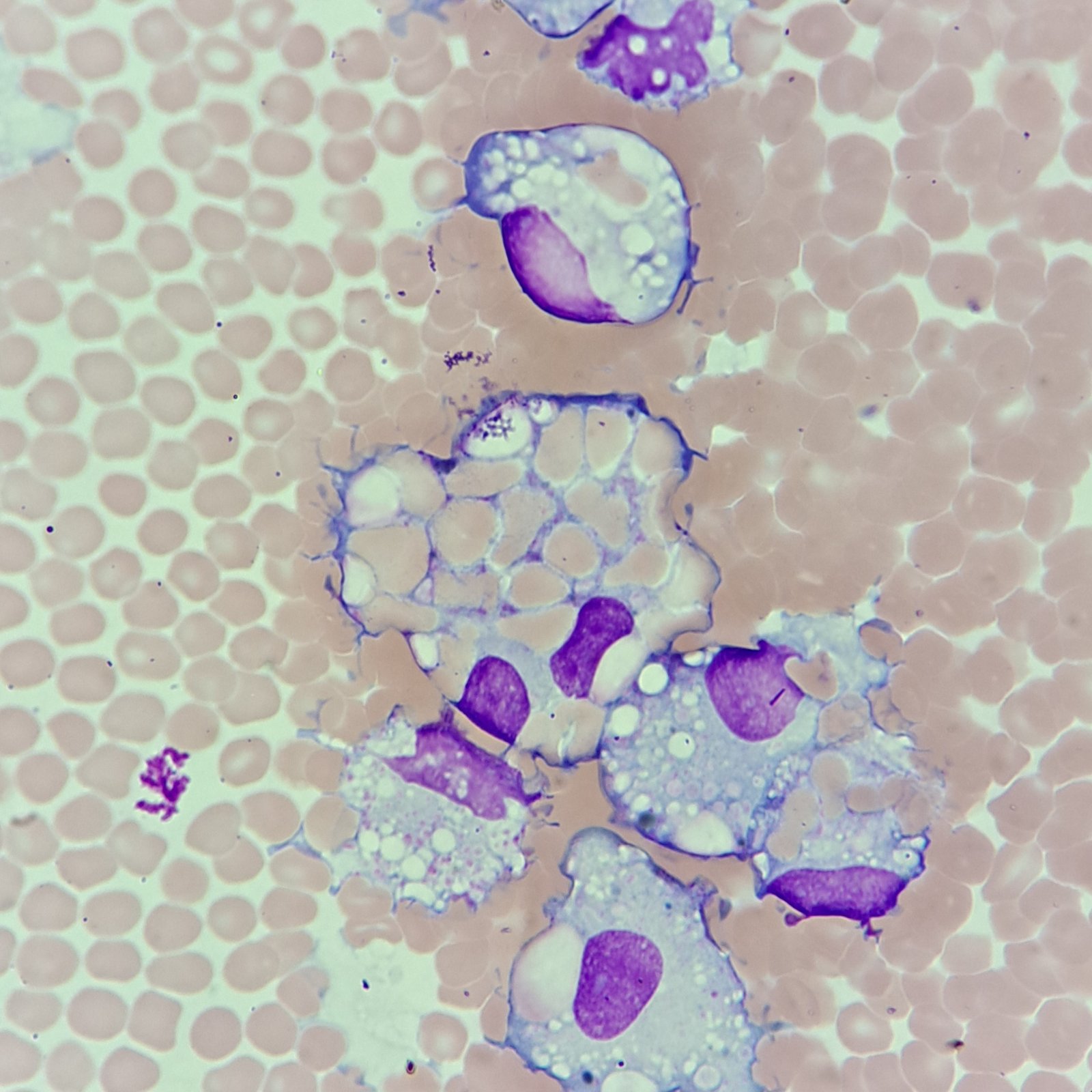 erythrophage: macrophage with engulfed red blood cells