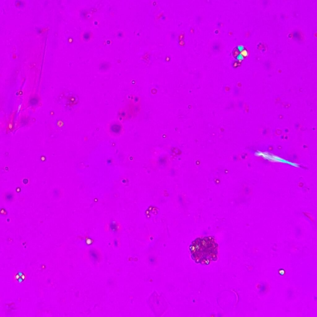 fat/lipid droplets in urine, polarized. Maltese crosses