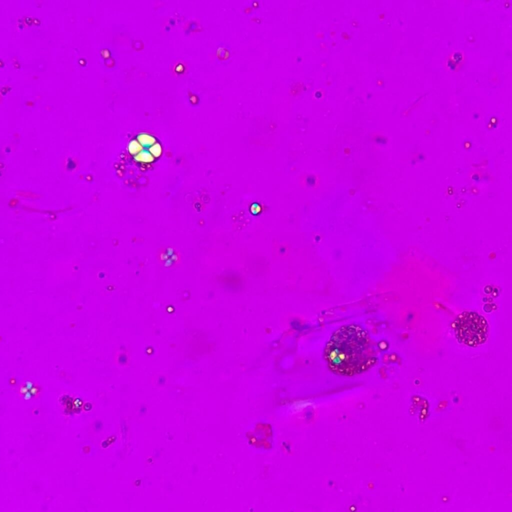 fat/lipid droplets in urine, polarized. Maltese crosses