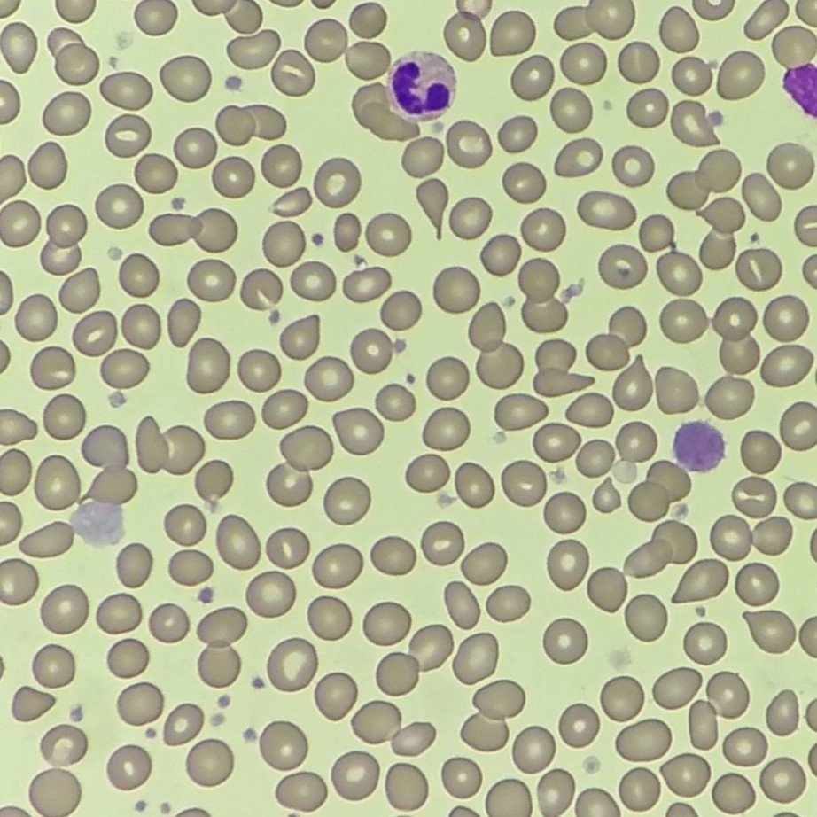 Giant Platelets