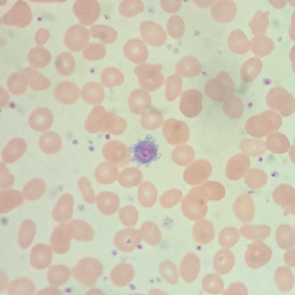 Giant Platelet
