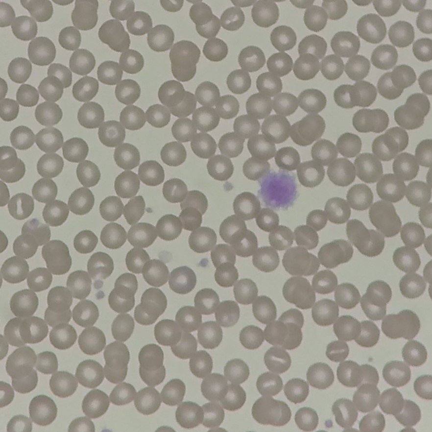 Giant Platelet
