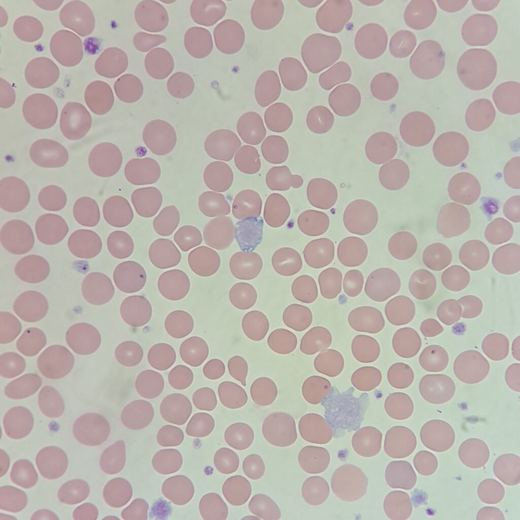 Giant and Large Platelets