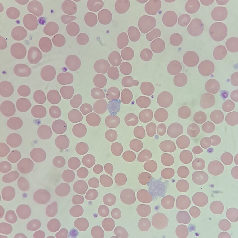 Thawed Platelets Platelets: Giant & Large, Clots & Clumps
